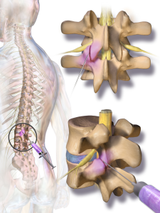 Facet Joint Injection Facet Joint Injection