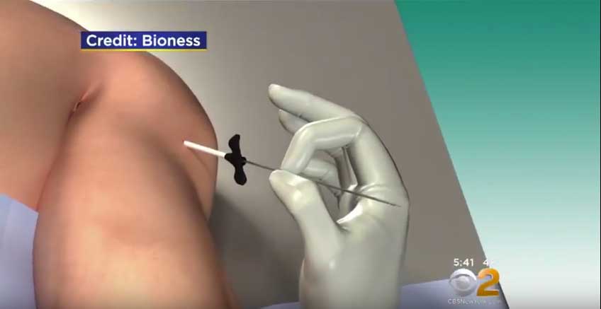 Bioness Peripheral Nerve Stimulator For Chronic Pain In Canada - Implant  Surgery & Treatment For Nerve Blocks