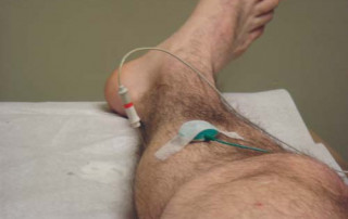 Needle Electromyography and Nerve Conduction Study