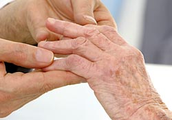 osteoarthritis - arthritis