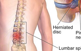 Internal Disc Disruption - Herniated Disc