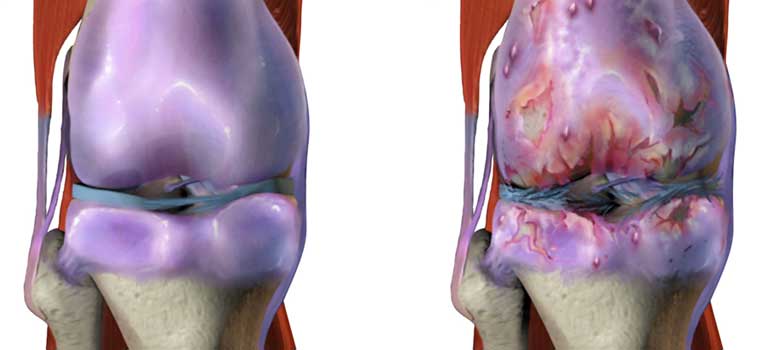 Knee Osteoarthritis (OA) - Pain Treatment & Therapy