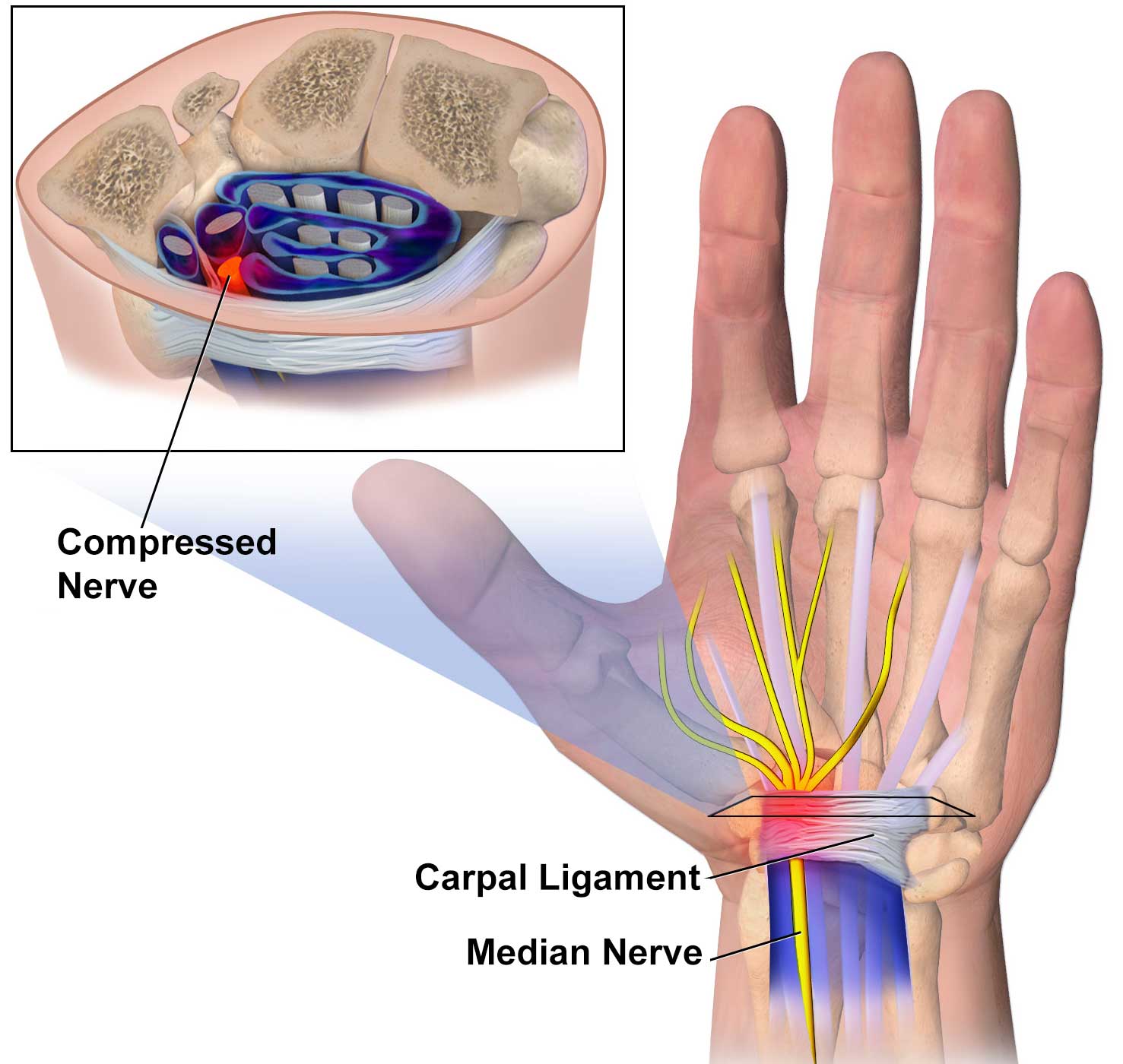 Carpal Tunnel Syndrome Treatment Yoga Kayaworkout co